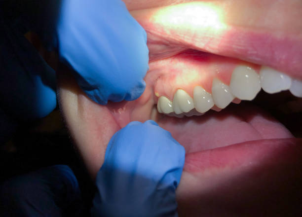 Best Emergency Care for Gum Disease in Washgton, IN